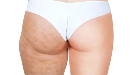 Conseils pour lutter contre la cellulite.