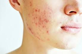 Why Professional Treatments Are A Sound Decision For Acne Cure?