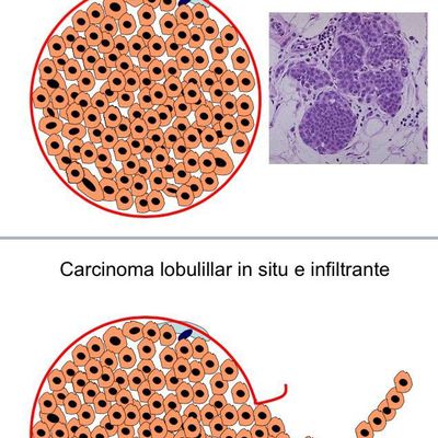 Carcinoma invasivo 