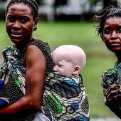 LES ALBINOS EN AFRIQUE NOIRE: COMBATTRE LES IDÉES REÇUES ET LES CRIMES RITUELS. - congo-objectif2050.over-blog.com