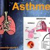 Bronchite asthmatique