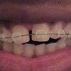 5e RDV: Changement fils dentaire 😰😥