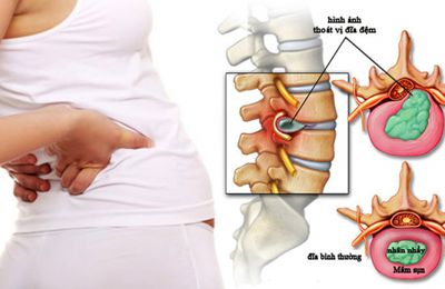 Đau lưng do thoát vị đĩa đệm và cách khắc phục