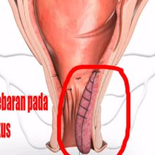 apa obat ambeien luar | obat ambeien selain lanaven