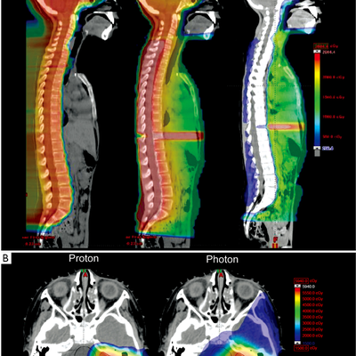 Radiothérapie - Proton contre photon : une autre lutte