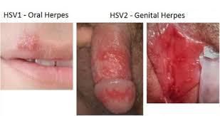 Bahaya herpes genital pria tidak di sembuhkan