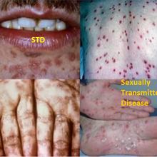 Sexually Transmitted Diseases (STD) Treatment Best Sexologist Doctor in india