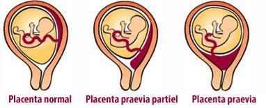 Placenta praevia sans saignement