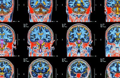 (EN) Article 7 janvier 2023 - pursuit.unimelb - What we now know about long COVID and our brains