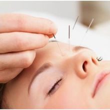 LIFTING PAR ACUPUNCTURE du visage : effet tonifiant, lissant et rajeunissant