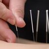 Qu'est-ce que l'acupuncture?