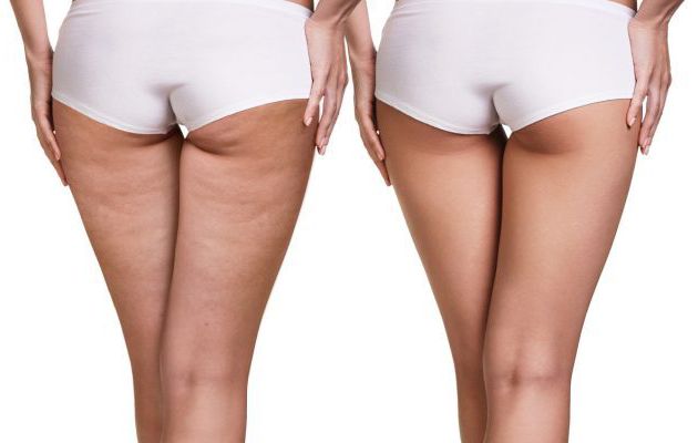 5 Non-invasive Cellulite Treatments You Never Tried To Know