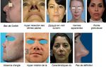 Rhinoplastie, ce qu'il FAUT savoir !