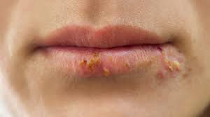 Cure For herpes simplex virus infection (HSV)