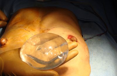chirurgie esthétique et prothése mammaire en photo.