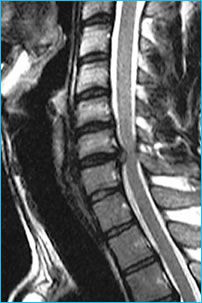 Symptome arthrose cervical