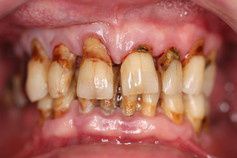 Les effets du tabac sur la santé bucco-dentaire.