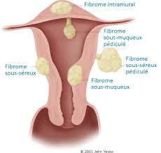 Les fibromes utérins sont des tumeurs toujours bénignes 