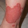 Les moyens de luttes anti-psoriasis