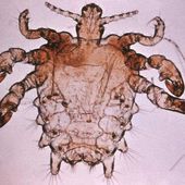 MST: Epilation définitive et extinction des morpions? - Doc de Haguenau