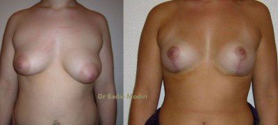 REDUCTION MAMMAIRE ET HYPERTROPHIE DES SEINS