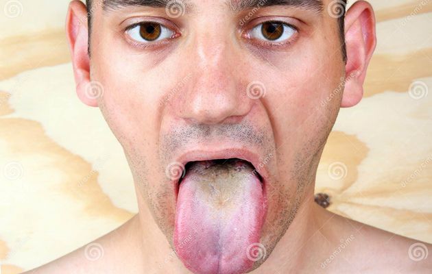 Infection levure bouche