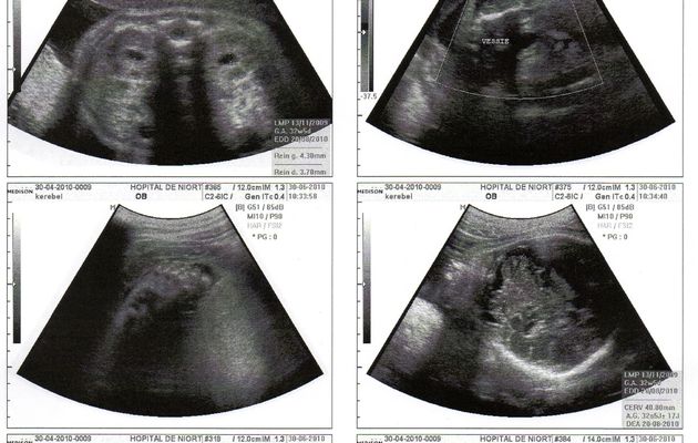 3ème échographie à 271 jours de grossesse faite le 30 juin 2010