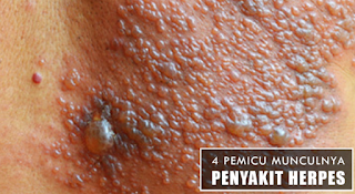 Obat Penyakit Herpes Alami