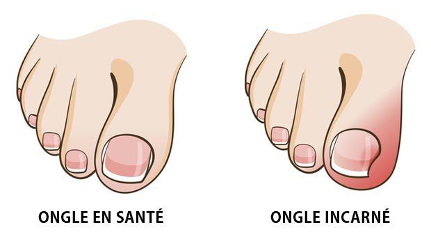 Prévenir et soigner un ongle incarné