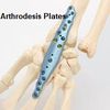  World Arthrodesis Plates Market Top Players Analysis Report 2025