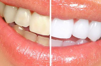 Les filles vous voulez retrouver des dents blanches ??? la solution c'est part ici !