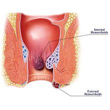 Apa Itu Penyakit Wasir Akut