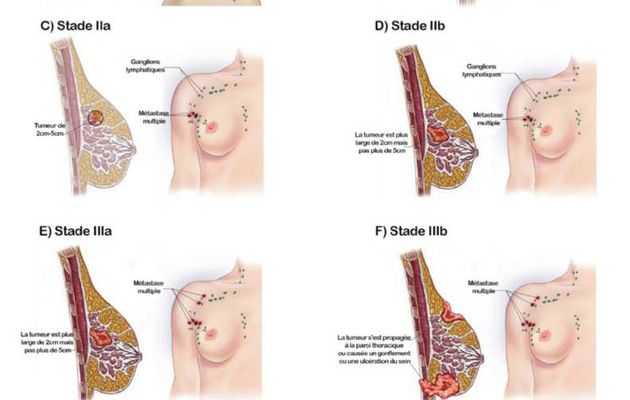 Os 5 tipos de câncer de mama