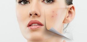 9 Poor Skin Habits Which Cause Acne
