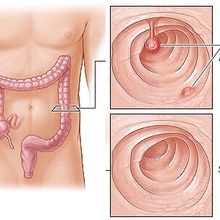  Điều trị polyp như thế nào?