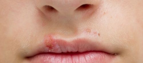 *** Comment stopper naturellement un herpès labial en une nuit ***