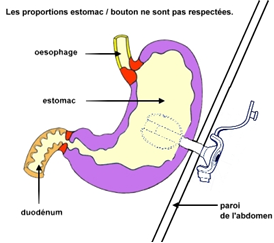 La gastrostomie