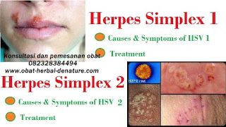 Penyebab Munculnya Herpes DI Kelamin