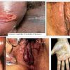 Obat Sifilis Wanita