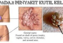 Obat Kutil Kelamin untuk ibu hamil yg aman manjur