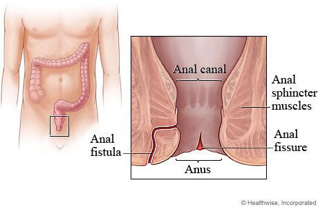 Menyembuhkan Penyakit Abses Anus