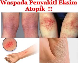 Harga Obat Gatal Gatal Terampuh Anjuran Dokter