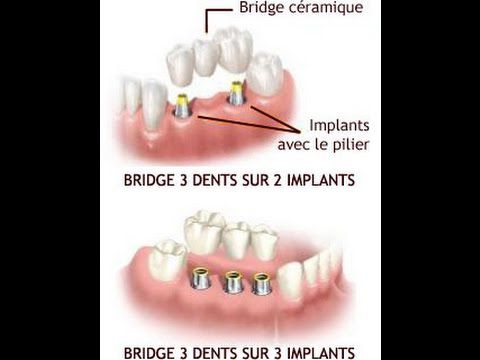 Implant dentaire prix