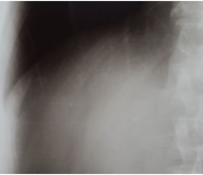 Cas clinique : Arthrose dorsale, de découverte fortuite