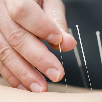 J'ai testé l'acupuncture 