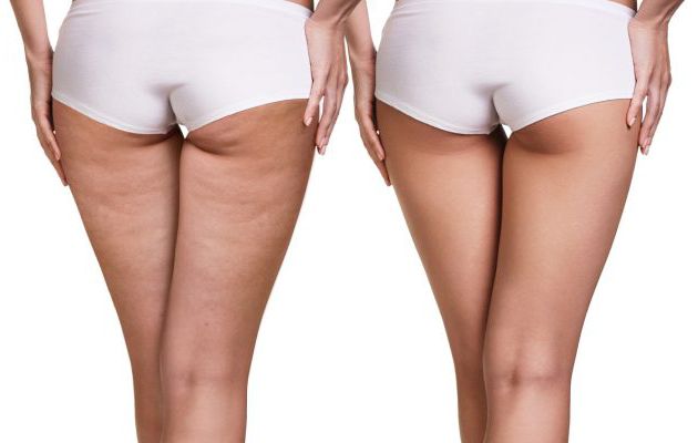 Cellulite Treatments – Quest To Find the Best Alternative in 2020