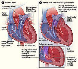 Malformation cardiaque benigne