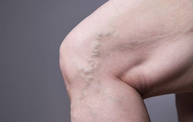 Tips For Preventing Vein Issues From Occurring 