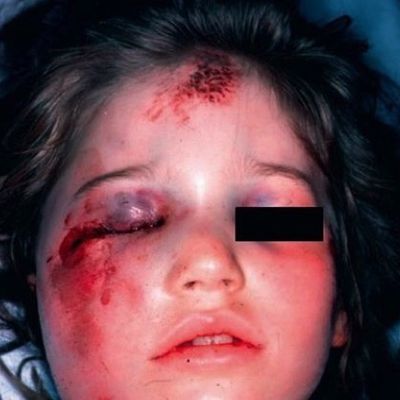 Reconnaître un enfant battu par les signes cliniques.