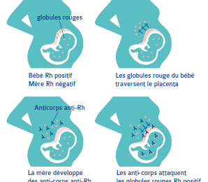 Incompatibilité foeto maternelle rhésus